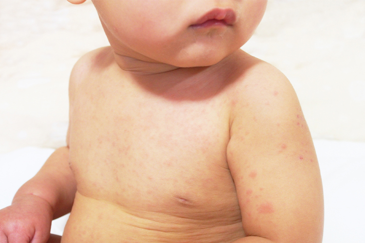 嬰兒濕疹的原因、症狀及肌膚護理方法