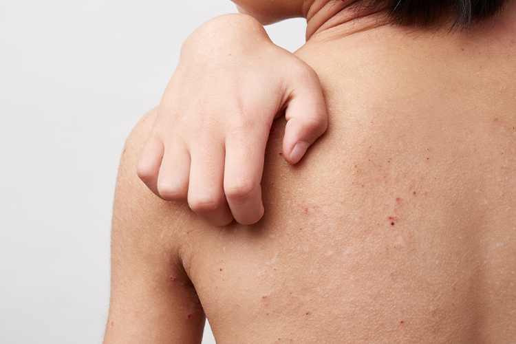 與異位性皮膚炎的區別在於是否反覆出現搔癢型濕疹